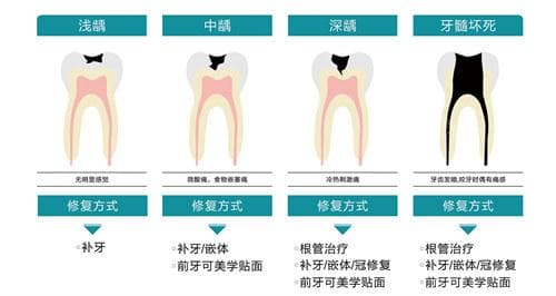 根管治疗后的牙齿能用一辈子吗？维护建议&注意事项&使用时间一览