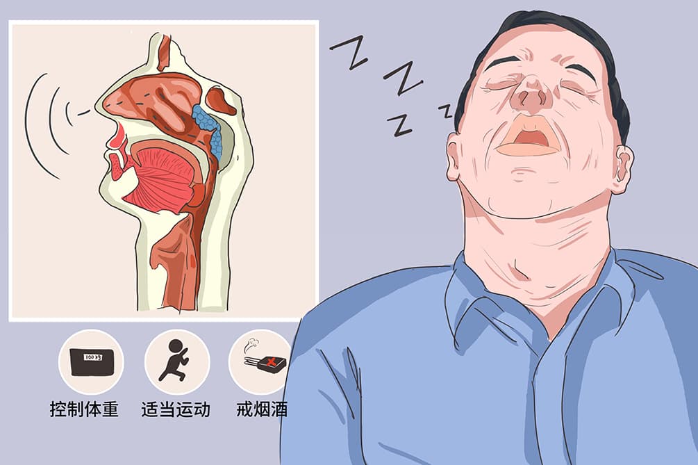 怎么治打呼噜男生最有效