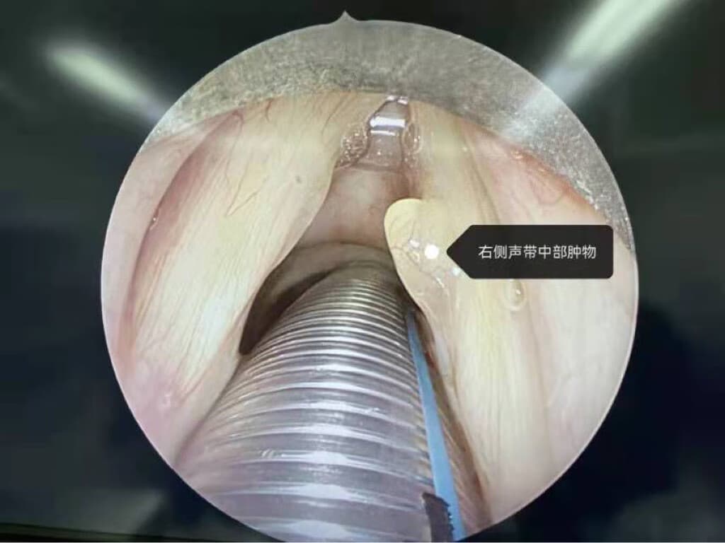 声带小结（息肉）术后并发症全解析