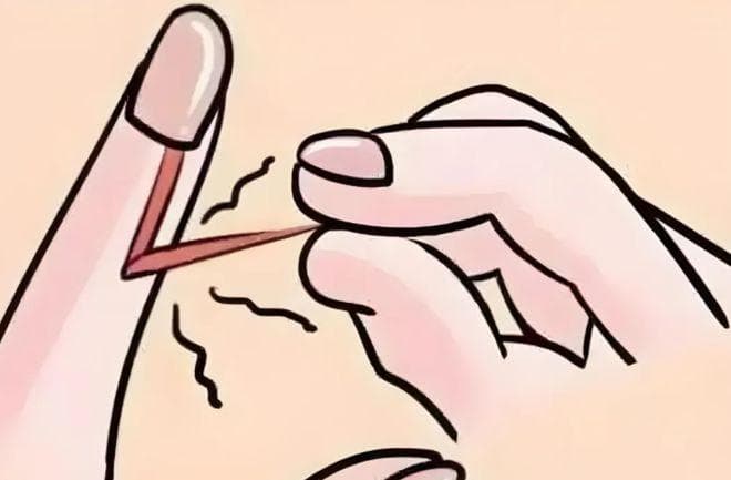 孩子手上长倒刺？当心细菌感染！正确处理方法在这里