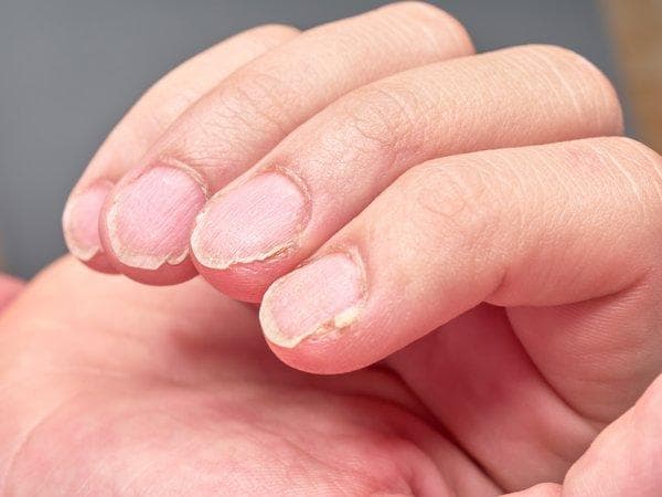 指甲感染杂色曲霉菌：症状、治疗与预防