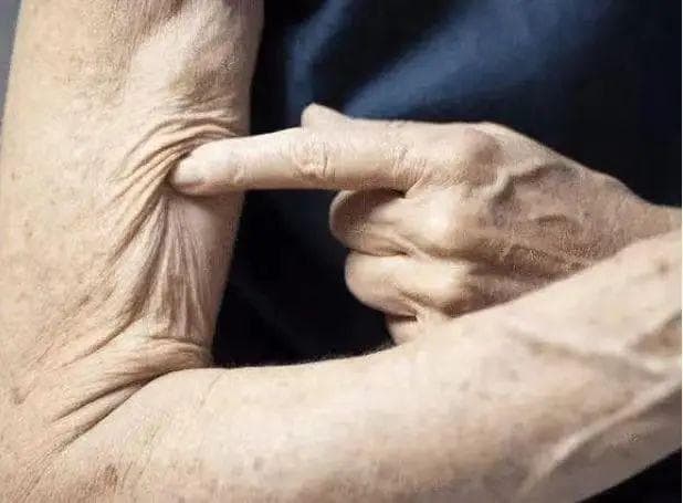 骨质疏松症、肌少症和肌少-骨质疏松症：定义、症状与防治全解析