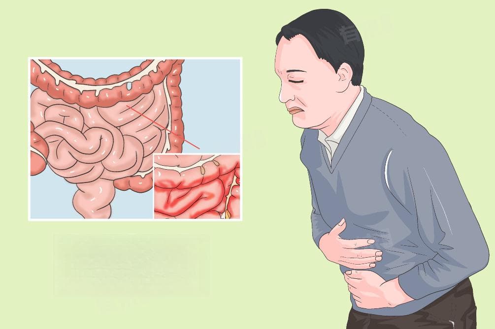 肠粘连怎么能检查出来