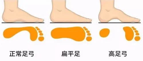 【健康科普】让家长担心的儿童“扁平足” 需要治疗吗？