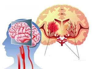 专家共识丨脑出血后遗症的治疗新突破：精准医疗与智能化康复