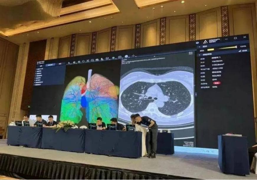 联影智能研发胸部CT三维重建AI系统，拥抱胸外科精准诊疗新路径