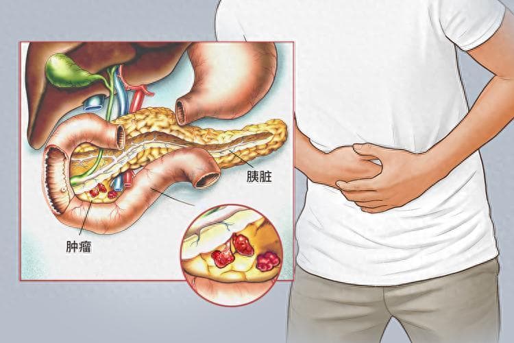 “癌王”胰腺癌很会伪装，身体出现4个异样，尽早排查病因