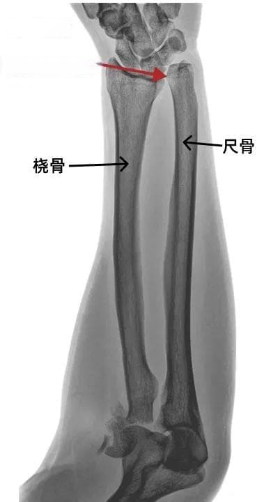 什么是TFCC？如何预防损伤