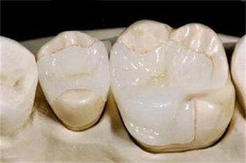 后槽牙掉落怎么办？专业解析掉了一颗或一小块的处理方法
