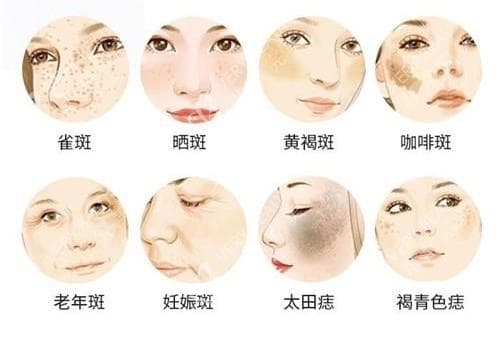 调Q激光和光子嫩肤哪个祛斑更好？二者各有其独特的优势和适用场景！