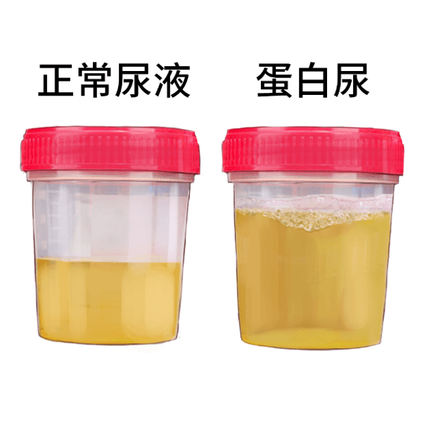 尿黄泡沫多怎么回事