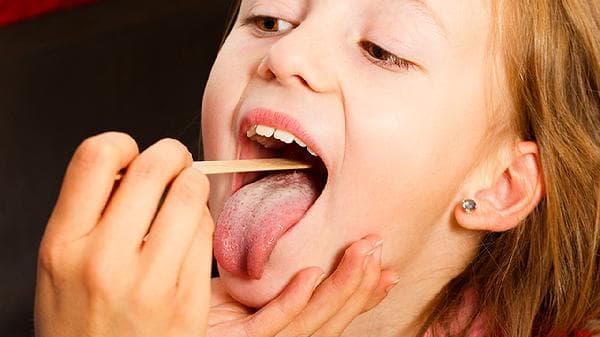 舌裂中医最佳治愈方法