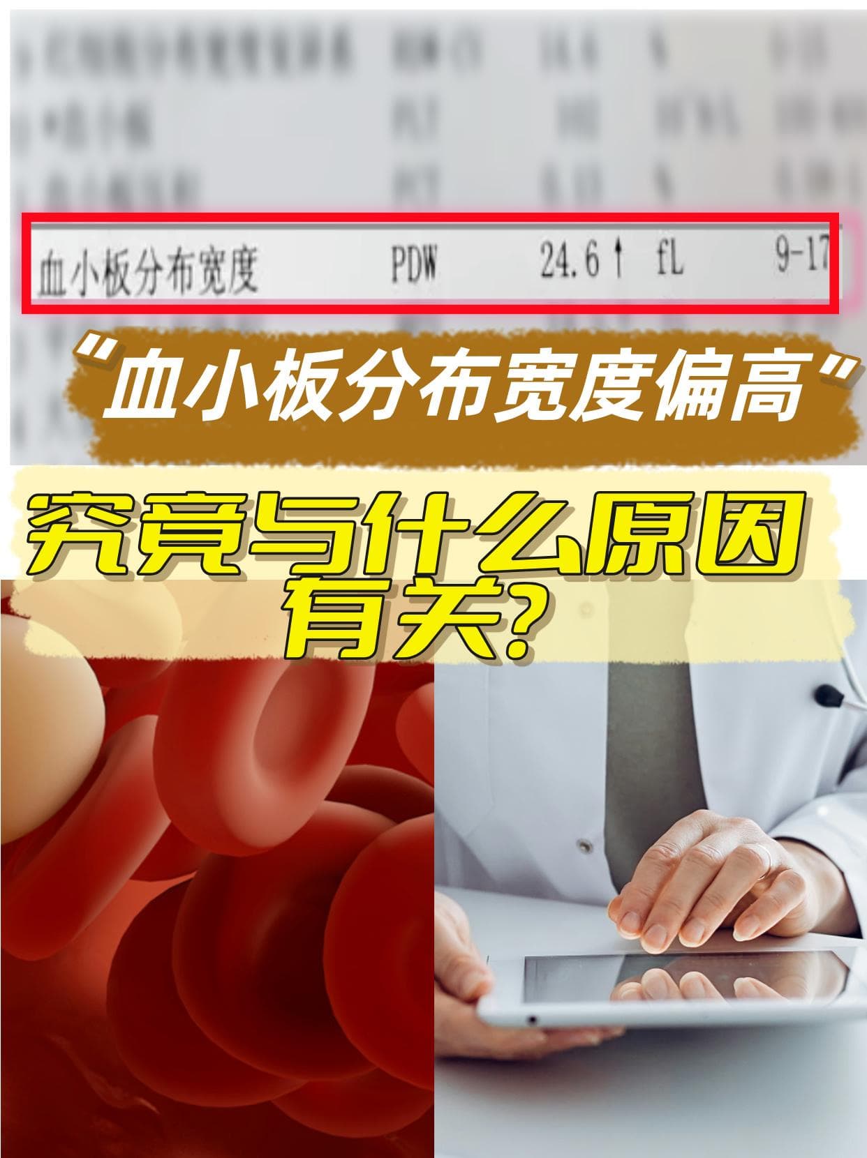 血小板分布宽度偏高，究竟与什么原因有关
