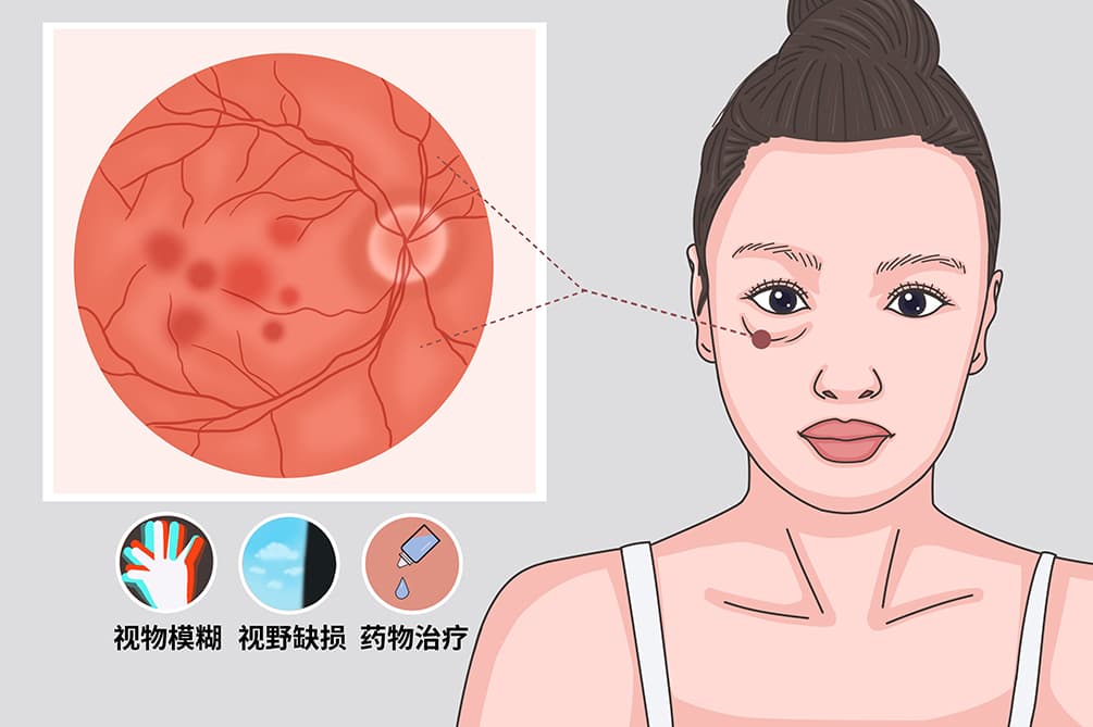 视盘水肿：症状、诊断与治疗全解析