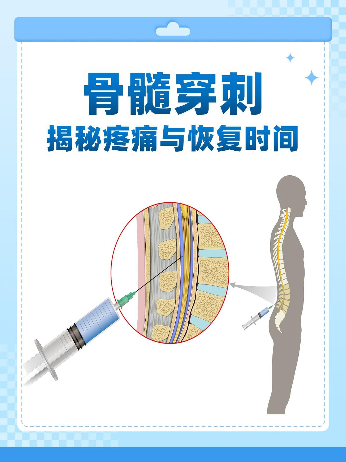 骨髓穿刺：揭秘疼痛与恢复时间