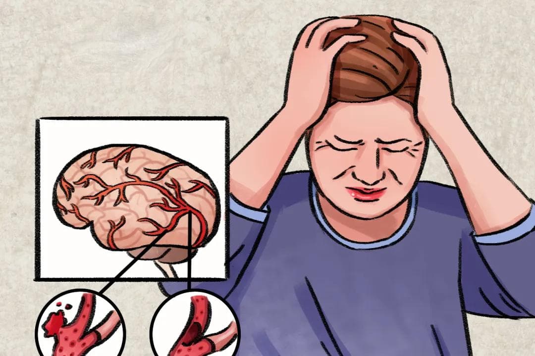 【健康科普】脑卒中早期康复：良肢位摆放方法