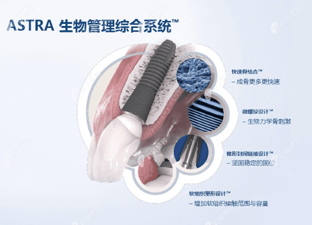 瑞典Astra种植体详解：优缺点、材质与使用寿命全解析