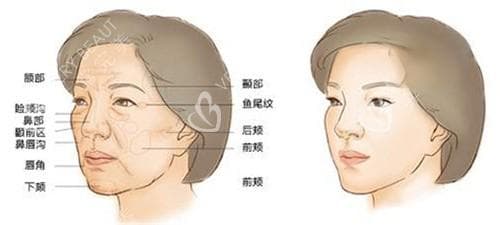 揭秘医美骨胶原：骨胶原蛋白与胶原蛋白的区别