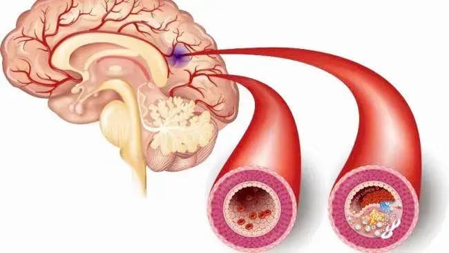 腔隙性脑梗塞怎么回事？什么原因引起的？注意这8个临床表现！