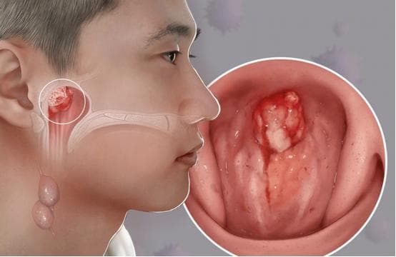 治疗鼻咽癌用这种疗法，生存率超过90%