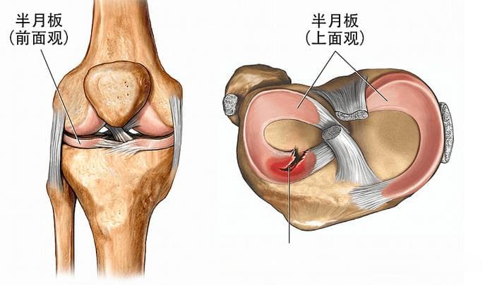 膝关节半月板损伤保守治疗指南