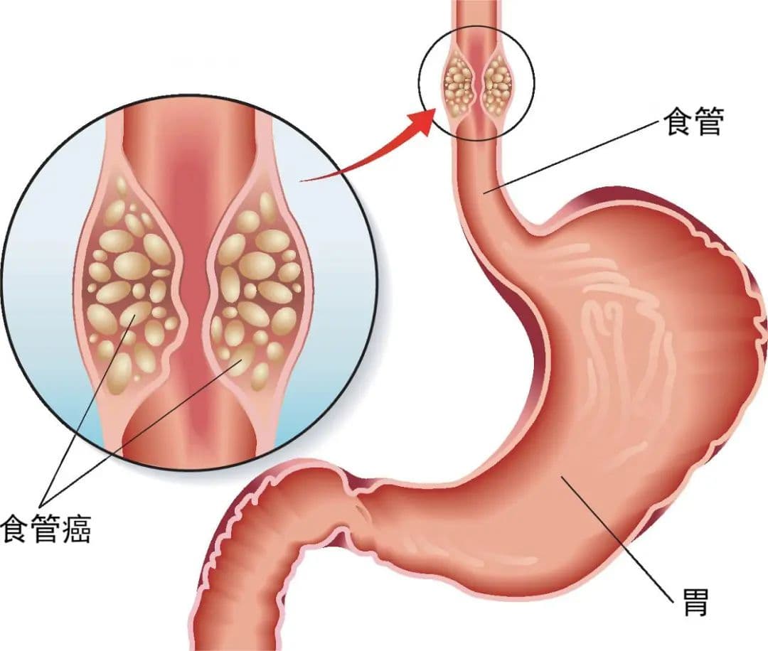 从吞咽困难到食管癌，这条危险之路你了解吗？