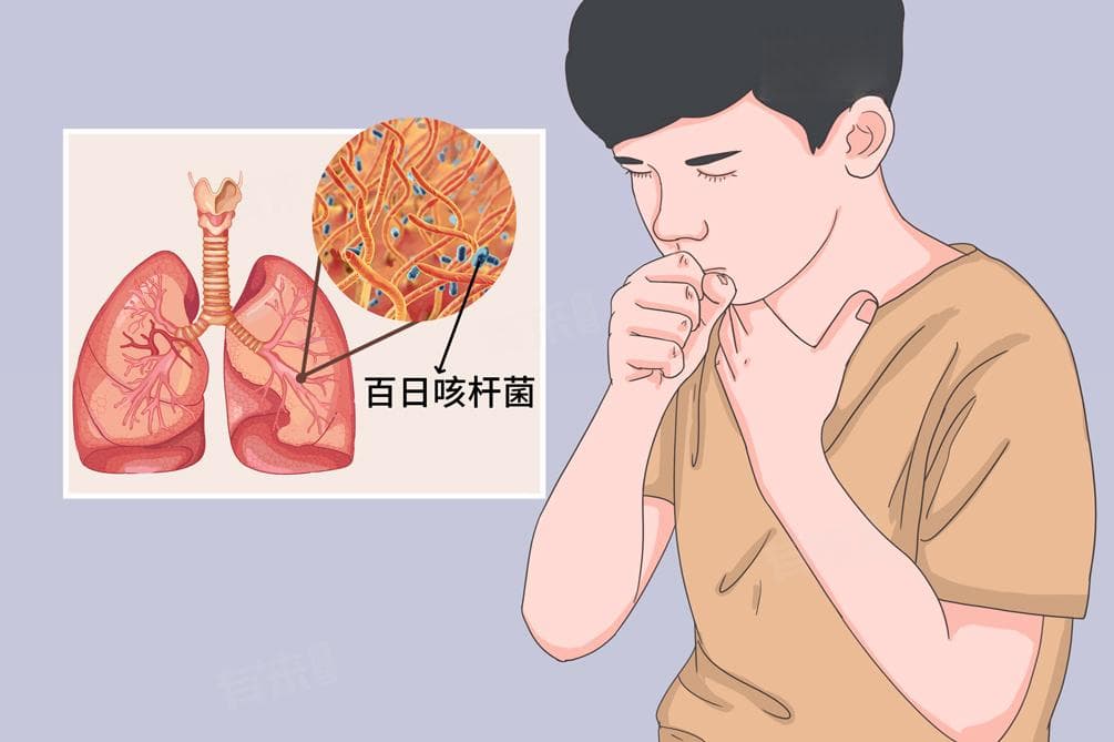 小孩百日咳的症状与治疗全解析