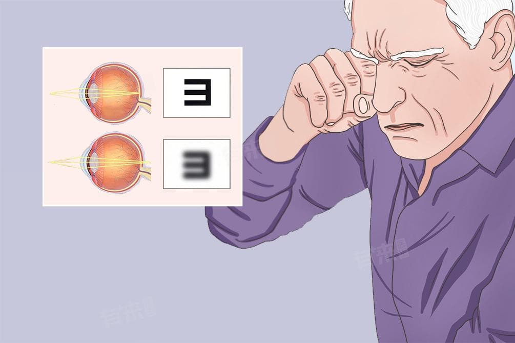 老花眼能治疗吗怎么治疗