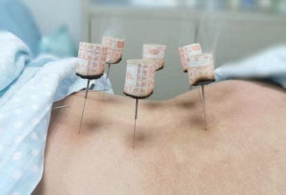中医针灸，助孕路上的好帮手