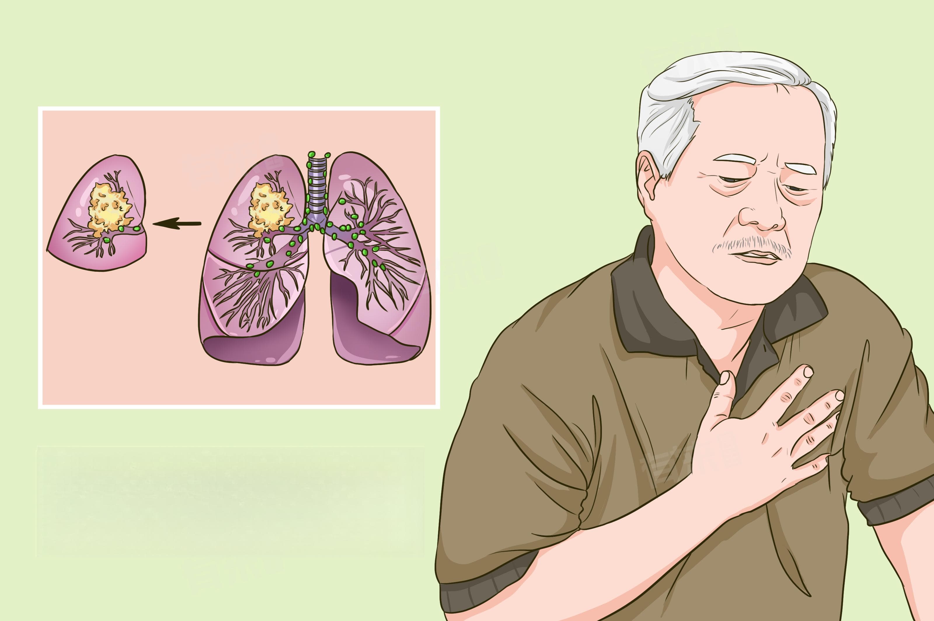 肺癌的早期症状和生存期指南