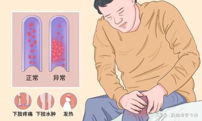 下肢静脉血栓的四大症状及危害