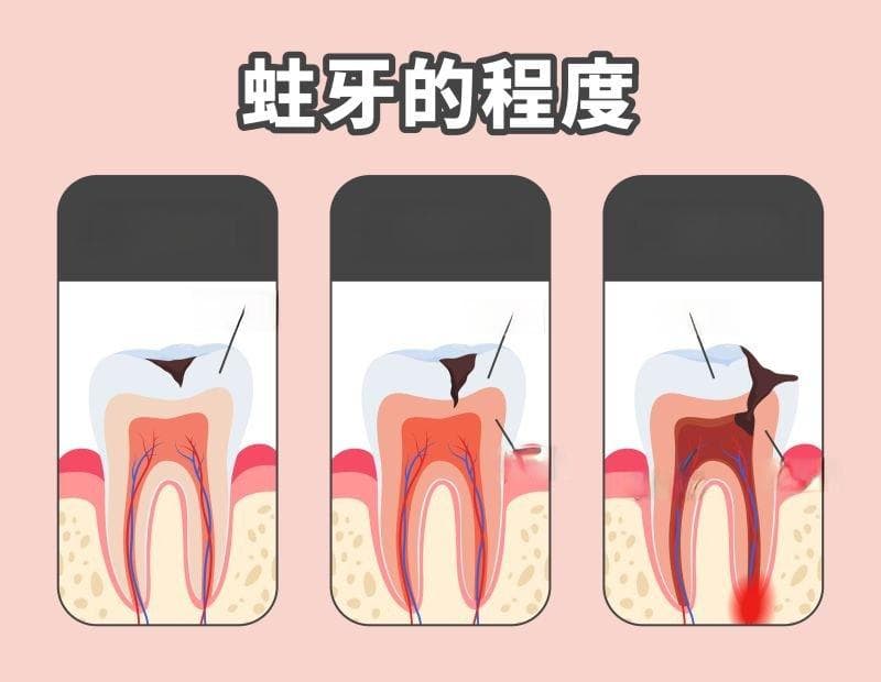 蛀牙怎麼辦？治療方法與如何避免再次蛀牙看這篇！