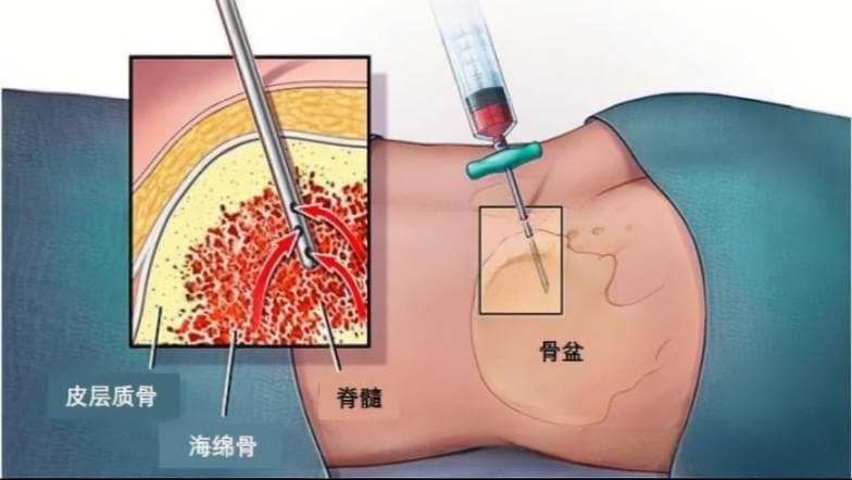 华西医院专家详解：骨髓穿刺和腰椎穿刺全攻略