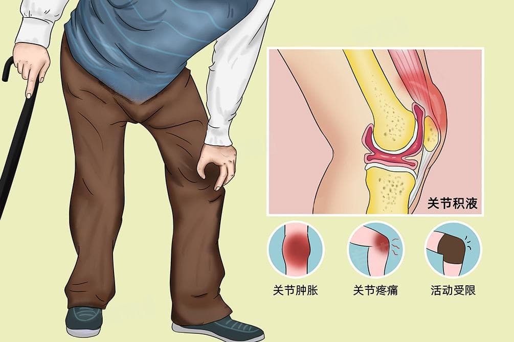 关节腔积液的成因及注意事项