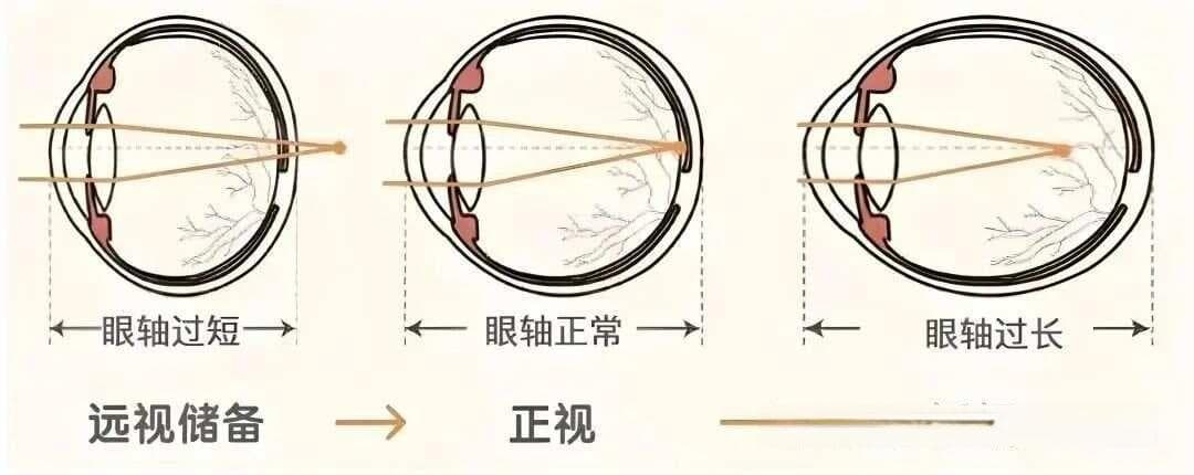 生物测量——近视防控一定要测眼轴