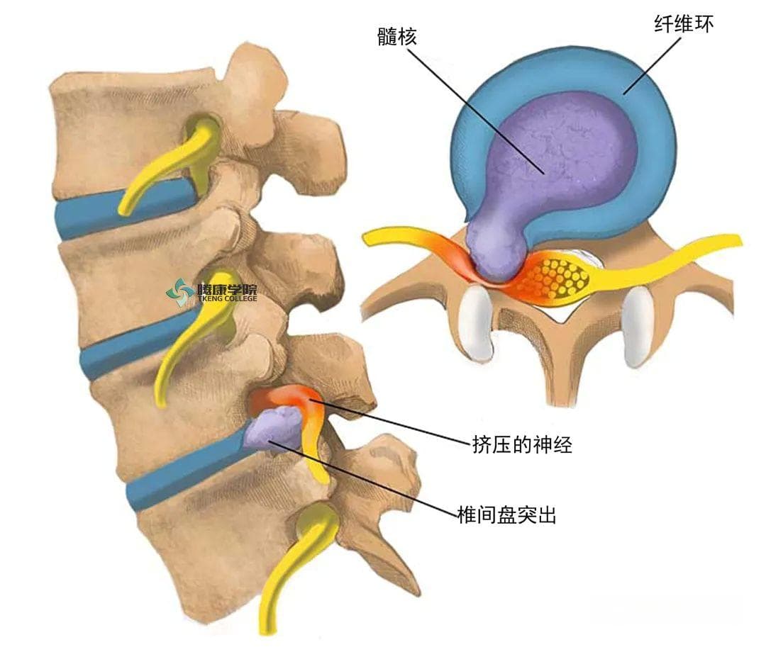 腰椎间盘突出症诊疗中国疼痛专家共识