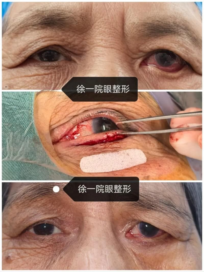 医疗资讯 | 眼睑外翻怎么办？ 别怕，专家帮你搞定它！