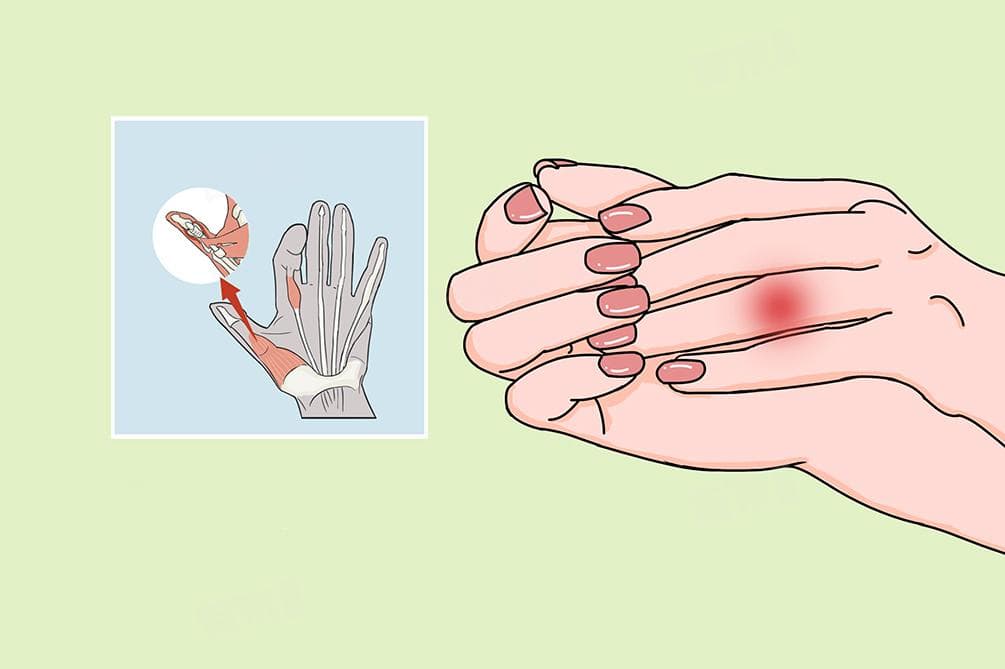 手腱鞘炎能自愈吗
