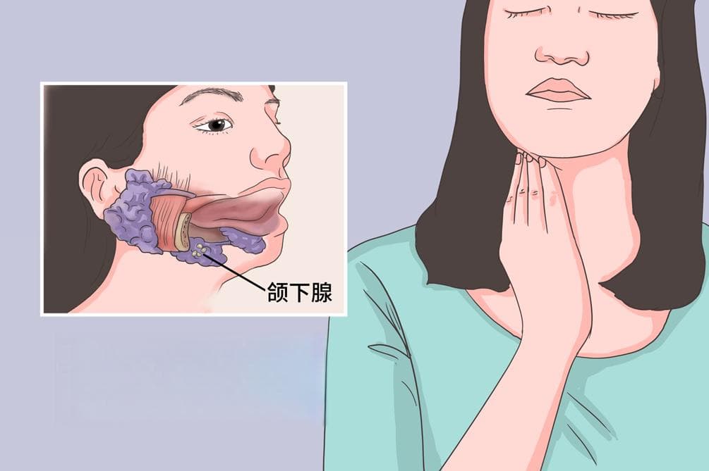 下颌下腺结石：症状、诊断与治疗全解析