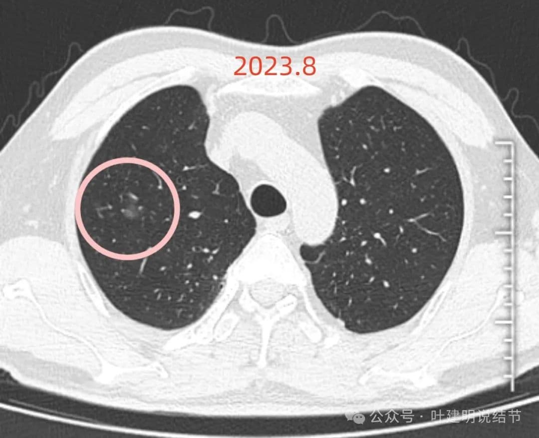肺结节诊断分析：医生建议手术，但影像学专家给出不同见解