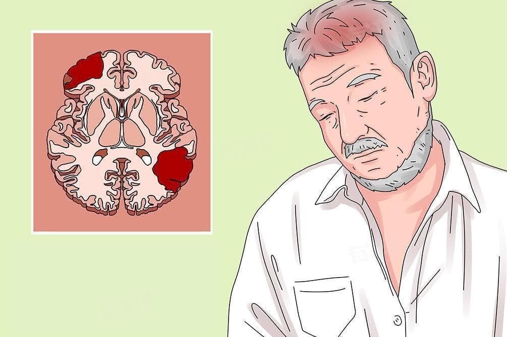 脑梗死应该挂什么科？一文详解就医指南