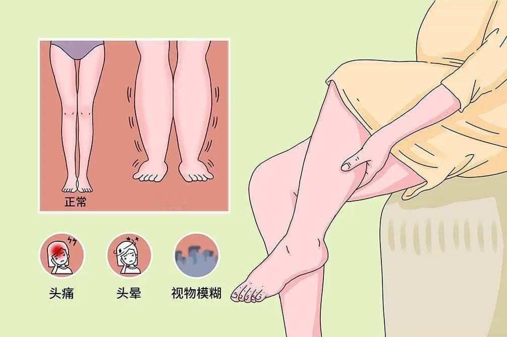 孕期双下肢水肿怎么办？原因分析与预防措施