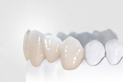 全瓷牙寿命揭秘：10至20年，这些因素影响使用时间