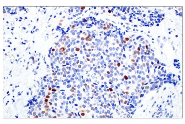 对抗 BRCA 突变癌症的新治疗方法