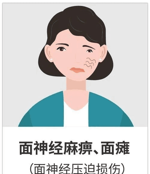 特发性面神经麻痹：深入认识“面瘫”，科学有效应对