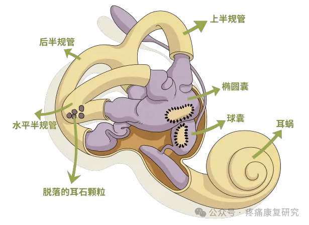 有一种眩晕叫“耳石症”，可从4个方面来鉴别