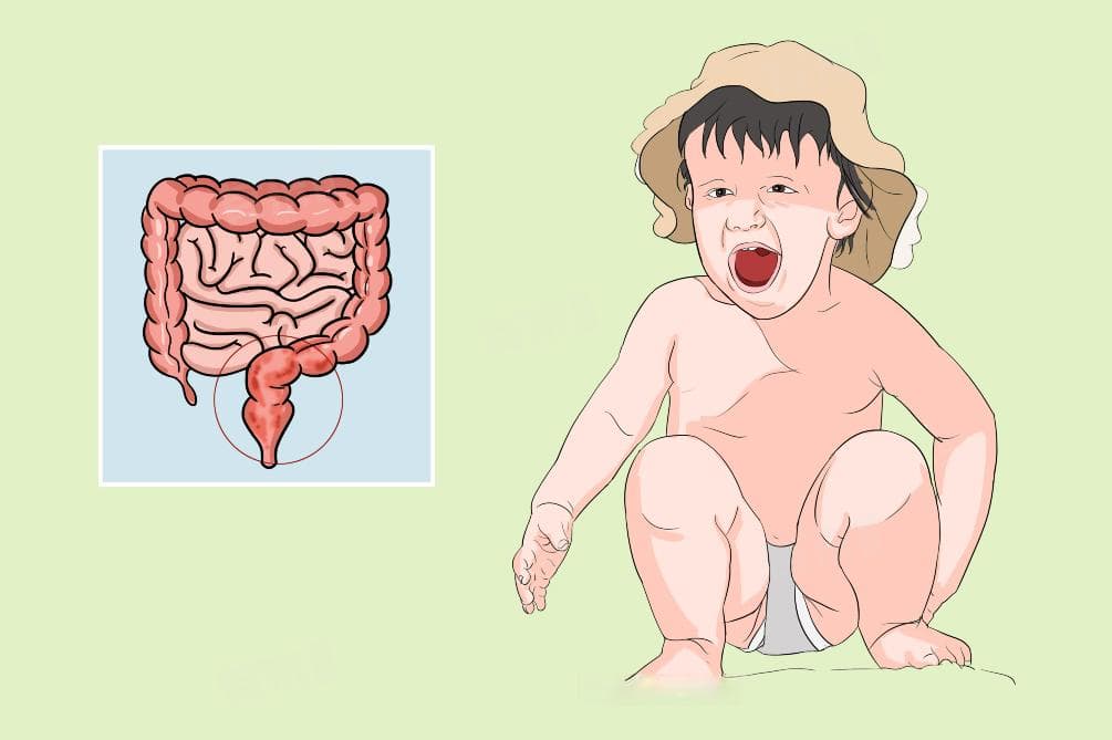 儿童便血的常见原因