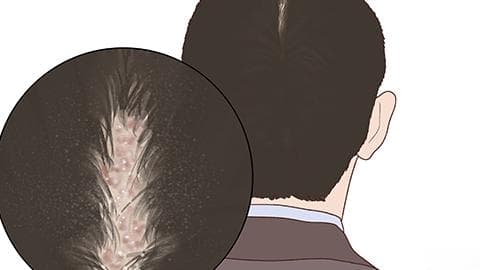 头屑多是什么原因