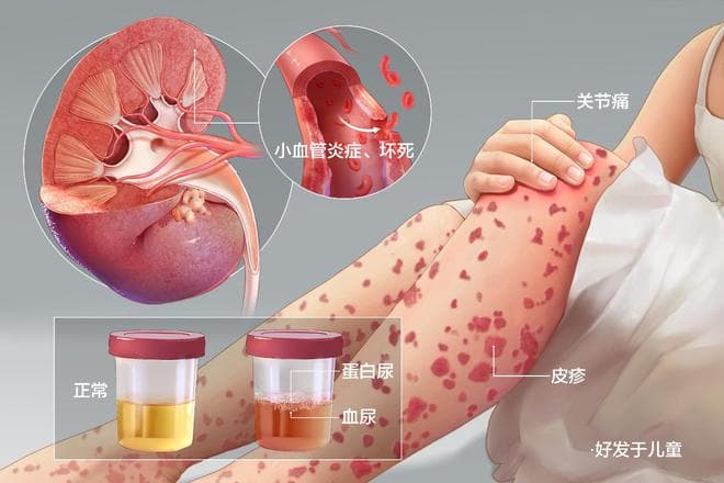 浅谈未来过敏性紫癜诊疗趋势：精准治疗模式是大势所趋