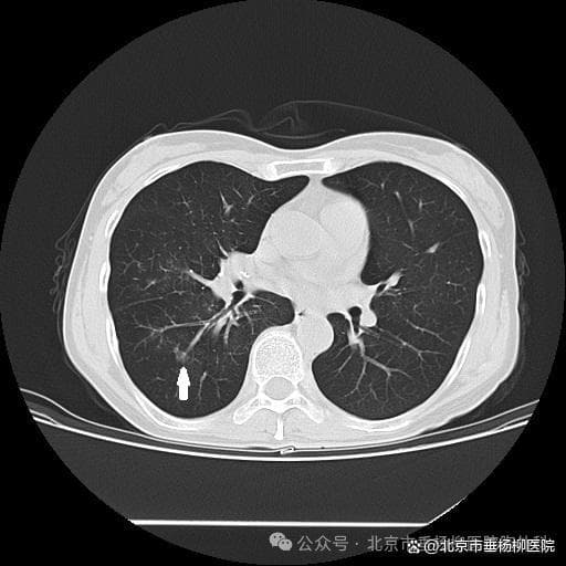 【垂医病例科普】胸外科：肺部磨玻璃结节的重要性｜不容忽视的健康警示